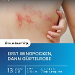 Erst Windpocken, dann Gürtelrose	